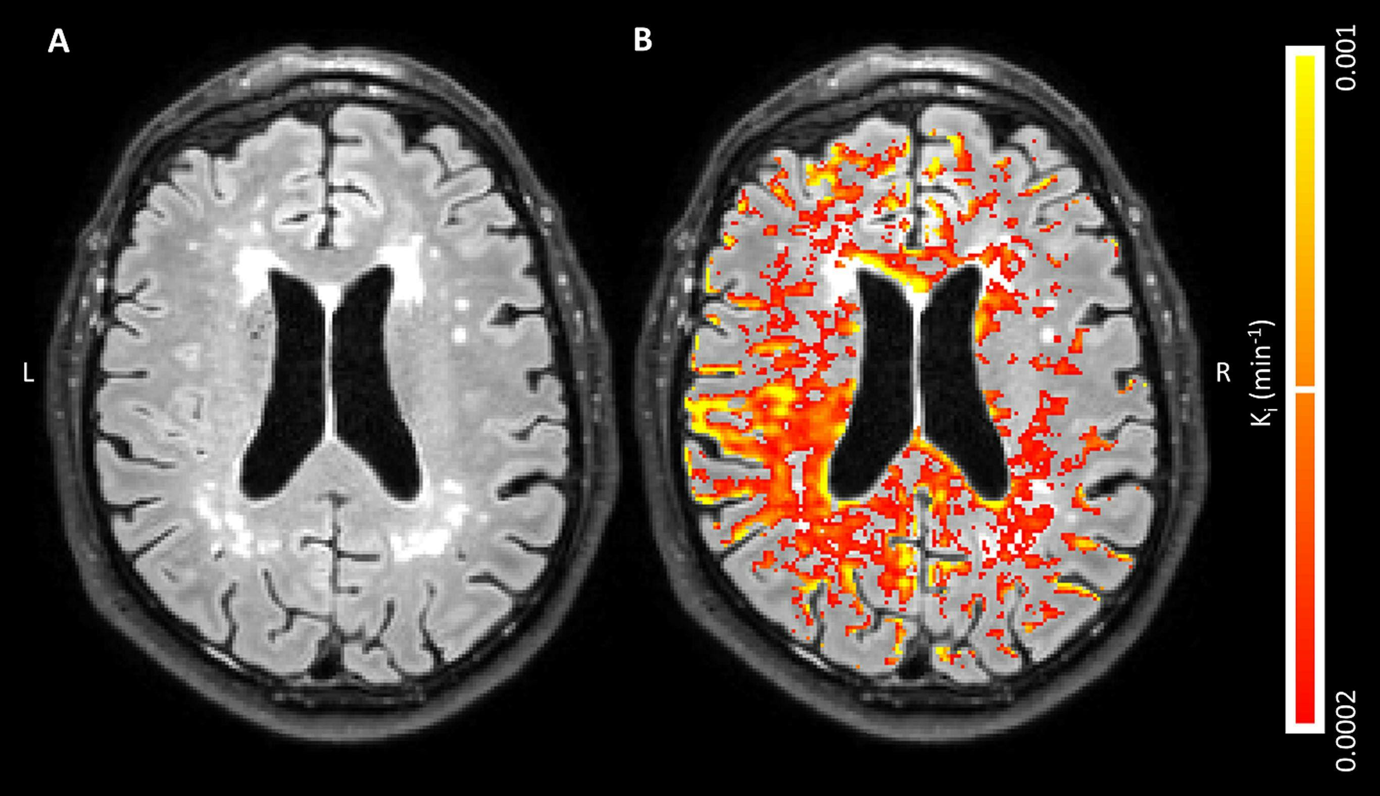 MRI Detects Blood/Brain Barrier Leaks in Early Alzheimer’s