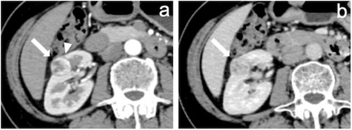Multicenter CT Study Shows Benefits of Emerging Diagnostic Model for Clear Cell Renal Cell Carcinoma