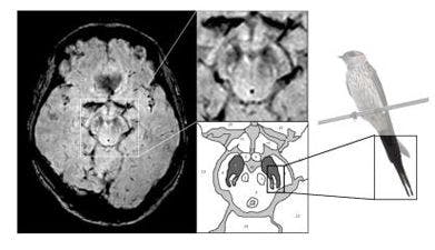 Brain MRI Detects Telling Sign of Parkinson’s Disease