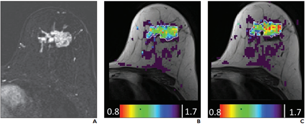 Gadolinium-Based Contrast Agent Does Not Change Diagnostic Accuracy of Breast Diffusion-Tensor Imaging