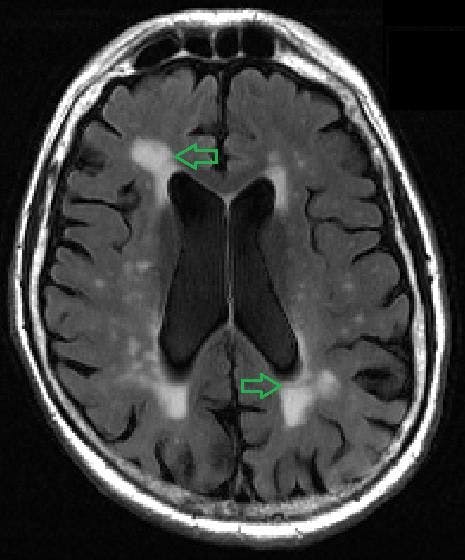 New Tool Used with MRI Better Detects White Matter Lesions