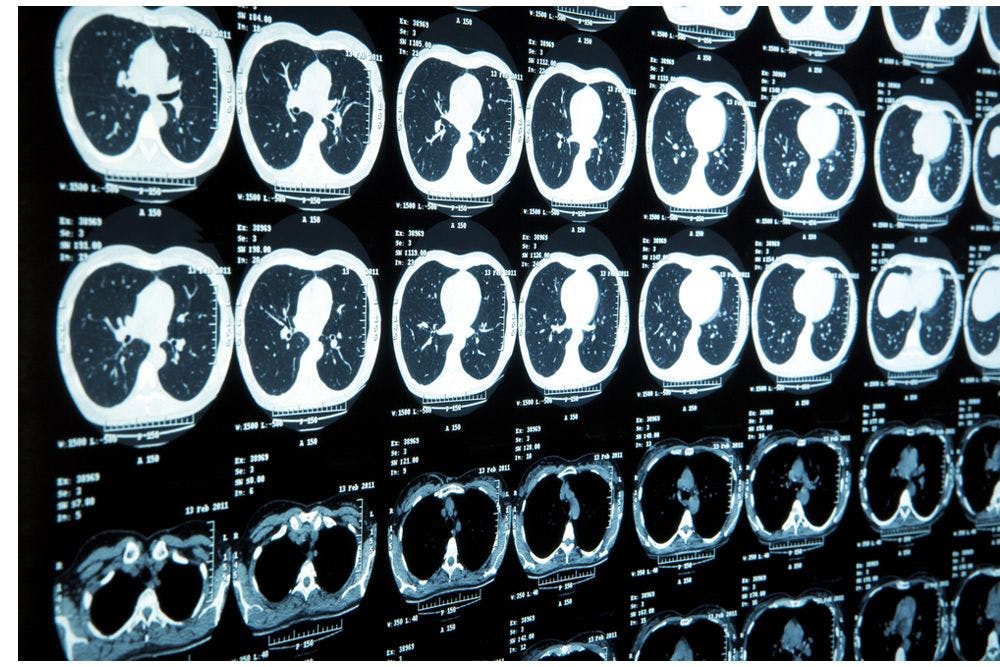 Many Early Lung Cancer Patients Receive Unnecessary Brain Scans