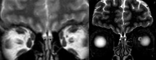 Brain Images Show Olfactory Impact in Patient with Early-Stage COVID-19 Infection