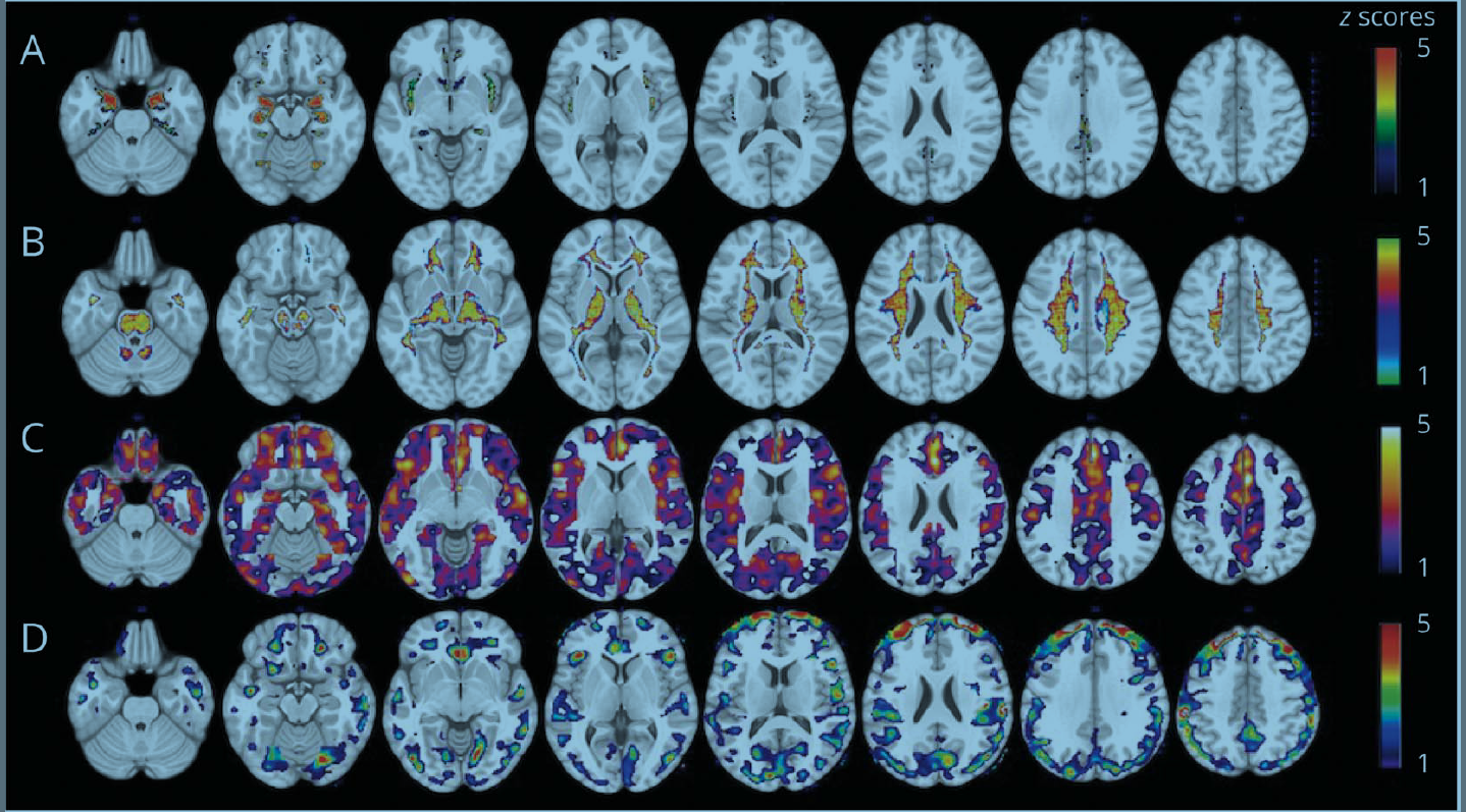 PET, MRI Identify What Increases Women’s Likelihood of Alzheimer’s