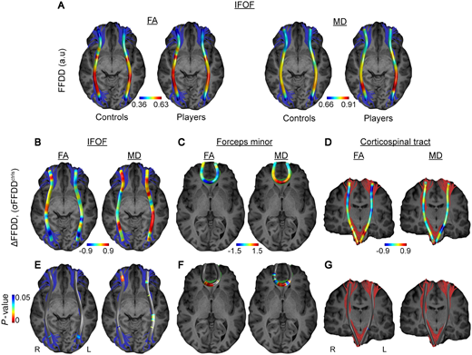 New MRI Test Identifies Neurodegenerative Disease in Football Players Earlier
