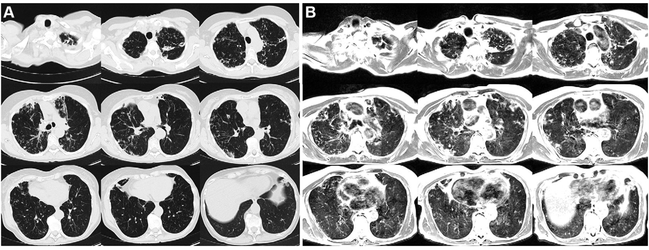 Axial multi-section imaging yielded full lung coverage using (A) CT (reformatted to 0.8 × 0.8 × 6 mm) and (B) T2-weighted MRI (1.1 × 1.1 × 6 mm) in a 69-year-old woman with bronchiectasis, cavitary lesions, and scattered pulmonary nodules.

Credit: RSNA