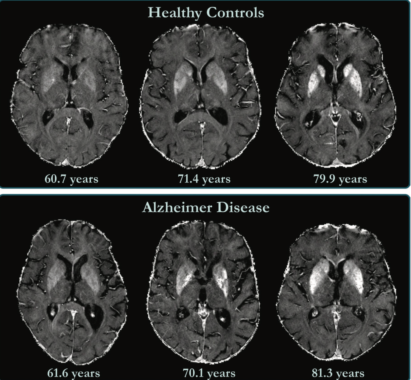 MRI Shows Link Between Higher Brain Iron Levels and Cognitive Decline in Alzheimer’s Patients