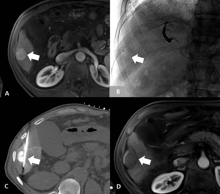 Figure 3. 64-year-old male with cirrhosis. A) Contrast-enhanced MRI in arterial phase shows a 3.5 cm enhancing mass in the inferior right lobe (arrow), consistent with HCC. B) Angiography performed after conventional TACE shows no blood flow in the right hepatic artery with the chemotherapeutic agent in the tumor (arrow). C) CT obtained during percutaneous microwave ablation shows the tumor, now hyperdense with chemotherapeutic agent, and the microwave ablation needle (arrow). D) Contrast-enhanced MRI in arterial phase obtained approximately four weeks after DEB-TACE shows a complete response to treatment (arrow).