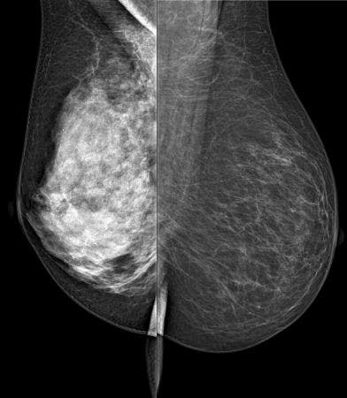 Spectral Mammography Could Measure Breast Density