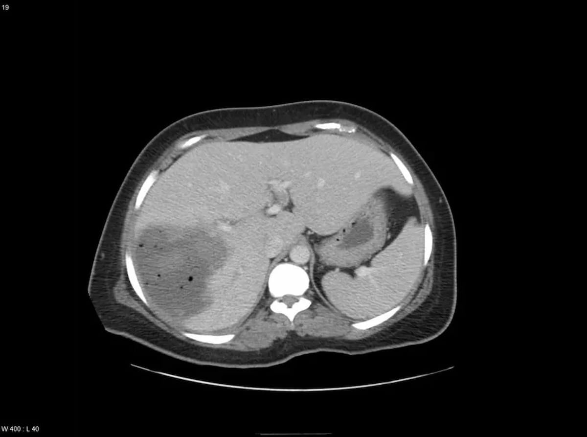 Image IQ Quiz: 45-Year-Old Patient with Elevated WBC and Right Upper Quadrant Pain