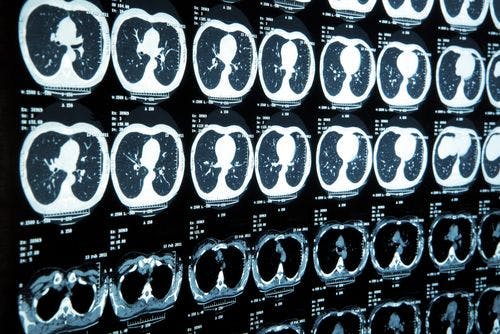 Brain MRI May Help Identify Vulnerability for PTSD
