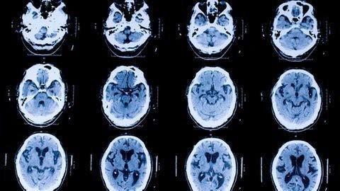 Non-Invasive Imaging Can Measure Cell Dysfunction in Patients with ALS