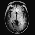 Initial Research Shows MRI Can Improve Liquid Biopsy for Brain Tumors