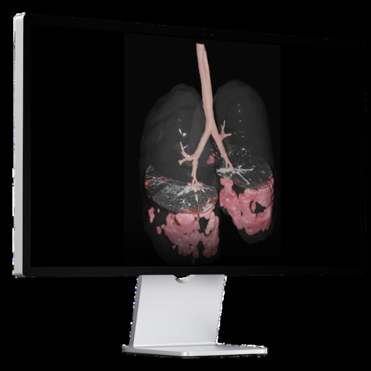 FDA Clears CT-Based AI Software for Assessing Interstitial Lung Disease