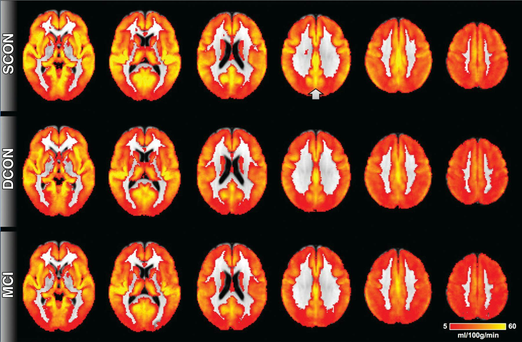MRI Technique May Show Cognitive Decline Before Symptoms