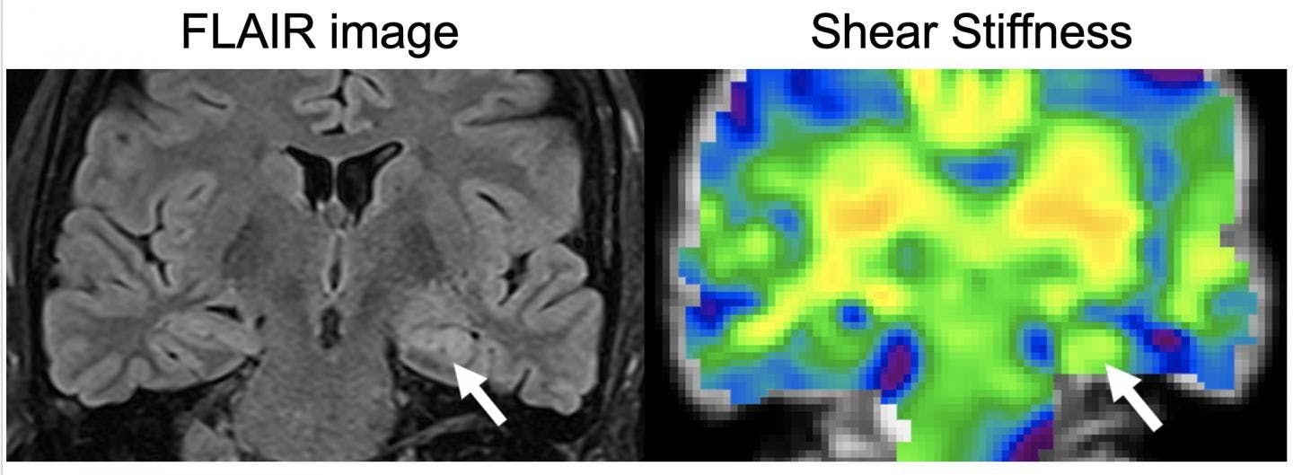 Magnetic Resonance Elastography Offers Early Detection of Epilepsy-Related Brain Changes
