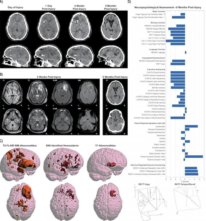 Global MRI Initiative Looks to Improve Brain Injury Treatment