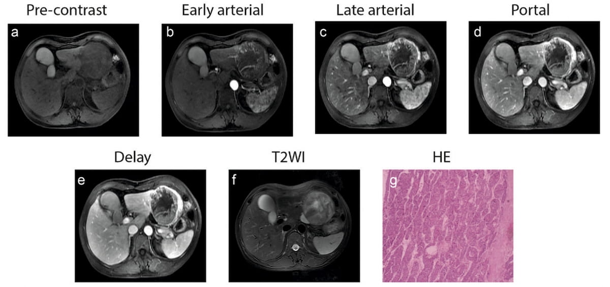 Deep Learning Model with DCE-MRI May Help Predict Proliferative Hepatocellular Carcinoma
