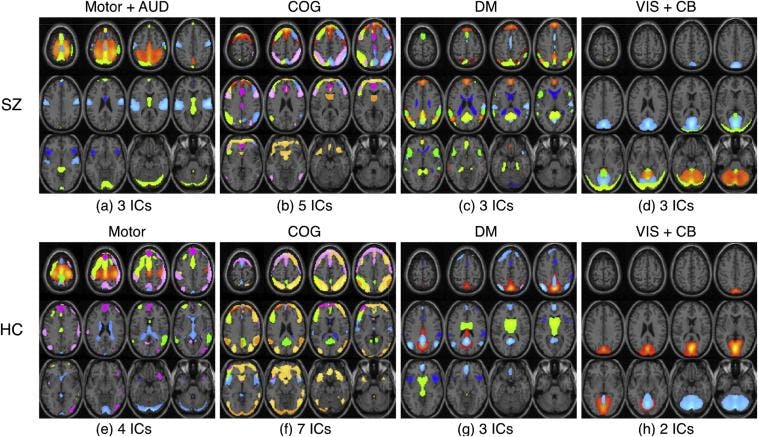 New fMRI Analysis Could Improve Schizophrenia Treatment