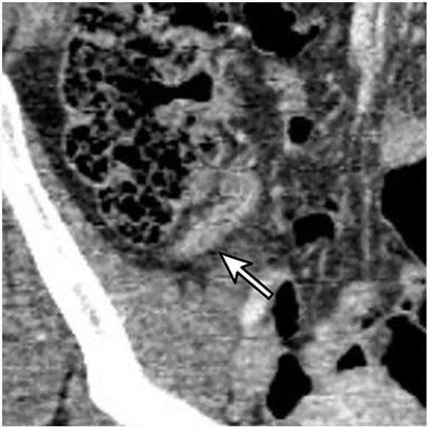 In a 28-year-old woman with right lower quadrant pain, coronal contrast-enhanced lower-dose (2 mSv) CT scan obtained with 4.0-mm section thickness and 1.0-mm reconstruction interval shows appendiceal wall thickening and mild periappendiceal fat infiltration (arrow). Patient was categorized to low-probability group for appendicitis by all five scoring systems, but as positive at CT. Appendicitis was pathologically confirmed after appendectomy.

Credit: RSNA