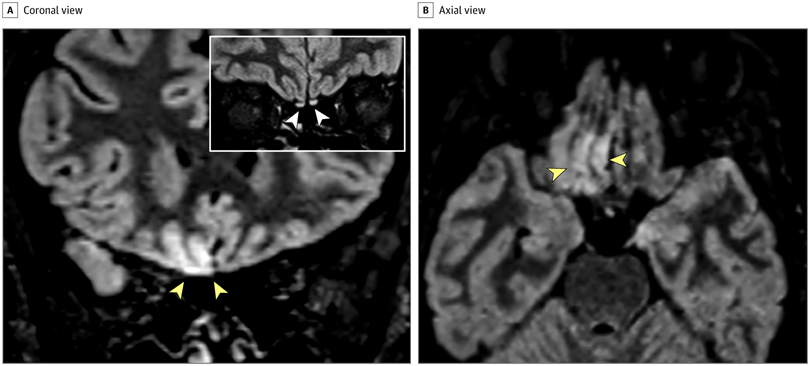 Brain Alterations Seen Via MRI in COVID-19-Positive Technologist