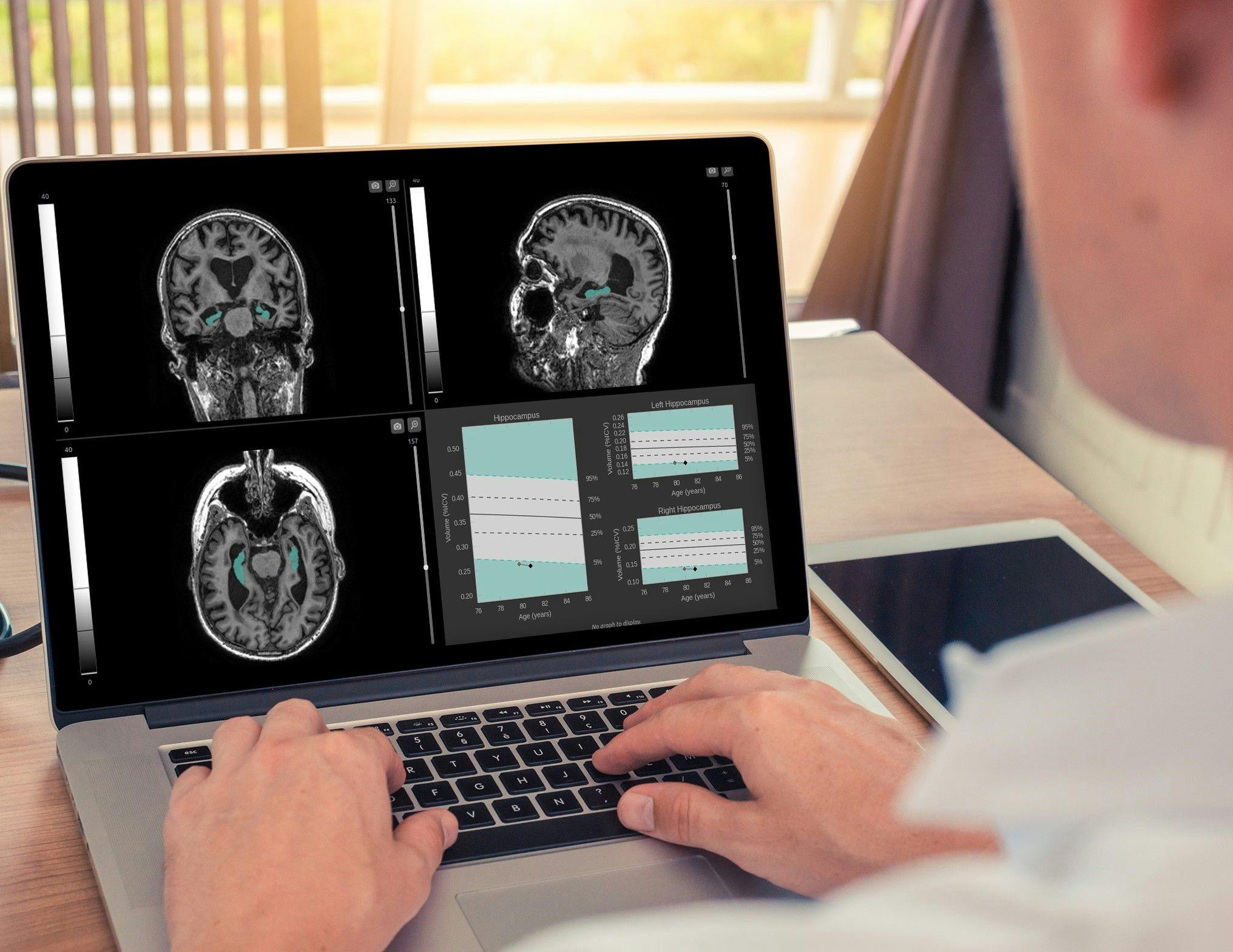Qynapse Secures FDA Clearance for Neurodegenerative Disease Imaging Software