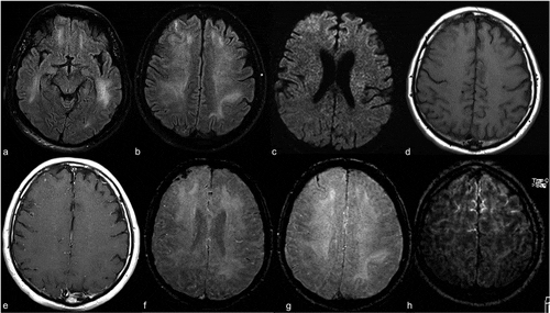 MRI Shows Brain Abnormalities in Some COVID-19 Patients