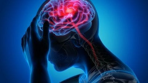 MRI Shows Cerebral Small Vessel Disease Common in Young Stroke Patients