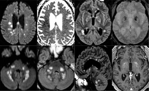 MRI Pinpoints Non-Stroke Abnormal Brain Findings in COVID-19-Positive Patients