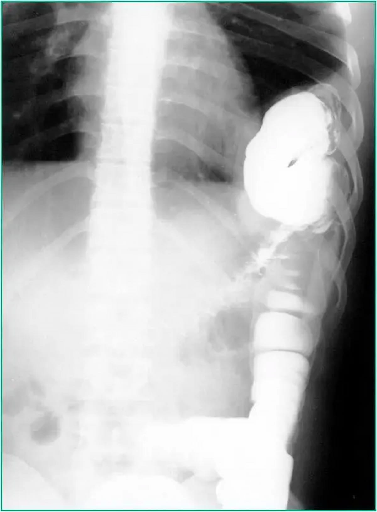 Image IQ Quiz: Patient with Abdominal Pain, Chest Pain and Difficulty Breathing