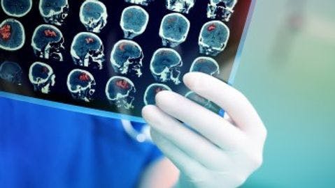 AI Model Uses MRI To Identify Brain Lesions Causing Mass Effect