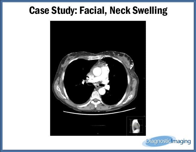 Facial, Neck Swelling