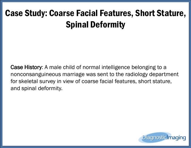 Coarse Facial Features, Short Stature, Spinal Deformity
