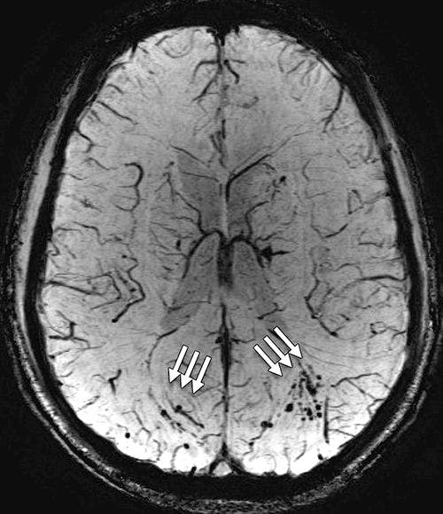 Visible Brain Damage Detected in MTBI From Blast Injuries