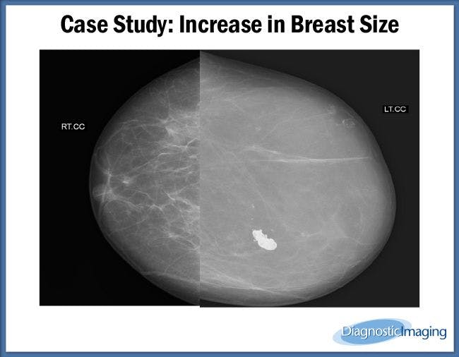 Increase in Breast Size