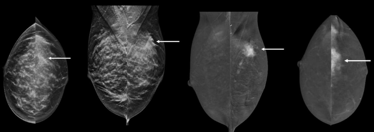 Contrast-Enhanced Mammography and Dense Breasts: What a New Meta-Analysis Reveals 