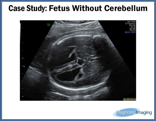 Fetus Without Cerebellum