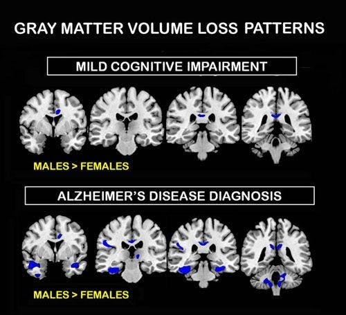 Alzheimer’s Differing Effects on Male, Female Brains