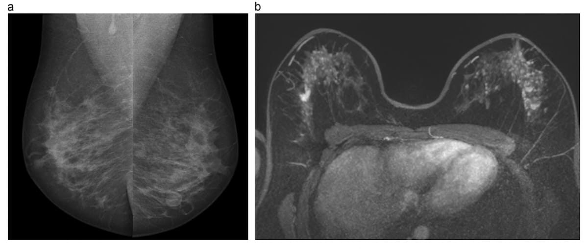 European Society of Breast Imaging Issues Updated Breast Cancer Screening Recommendations