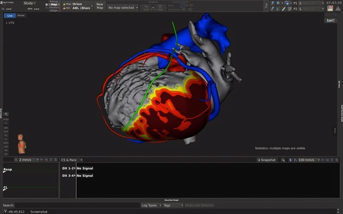 FDA Clears AI-Powered CT Segmentation Tool for Creating 3D Heart Models 
