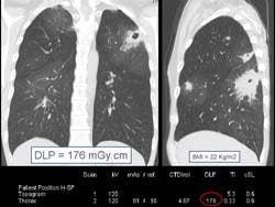 Multislice CT provides boost for COPD patients, but dose concerns persist