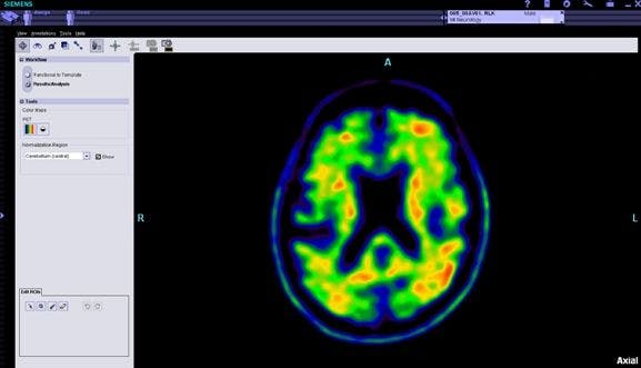 Amyloid Imaging: The Next Frontier in Alzheimer’s Care