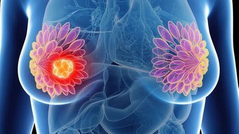 Adding Liquid Biopsy to Breast Imaging Could Improve Accuracy