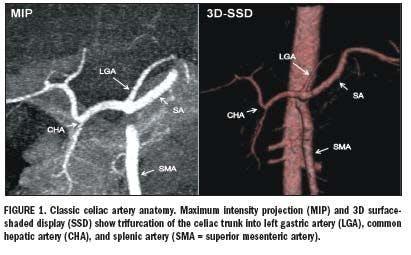 Multislice CTA depicts celiac artery variants
