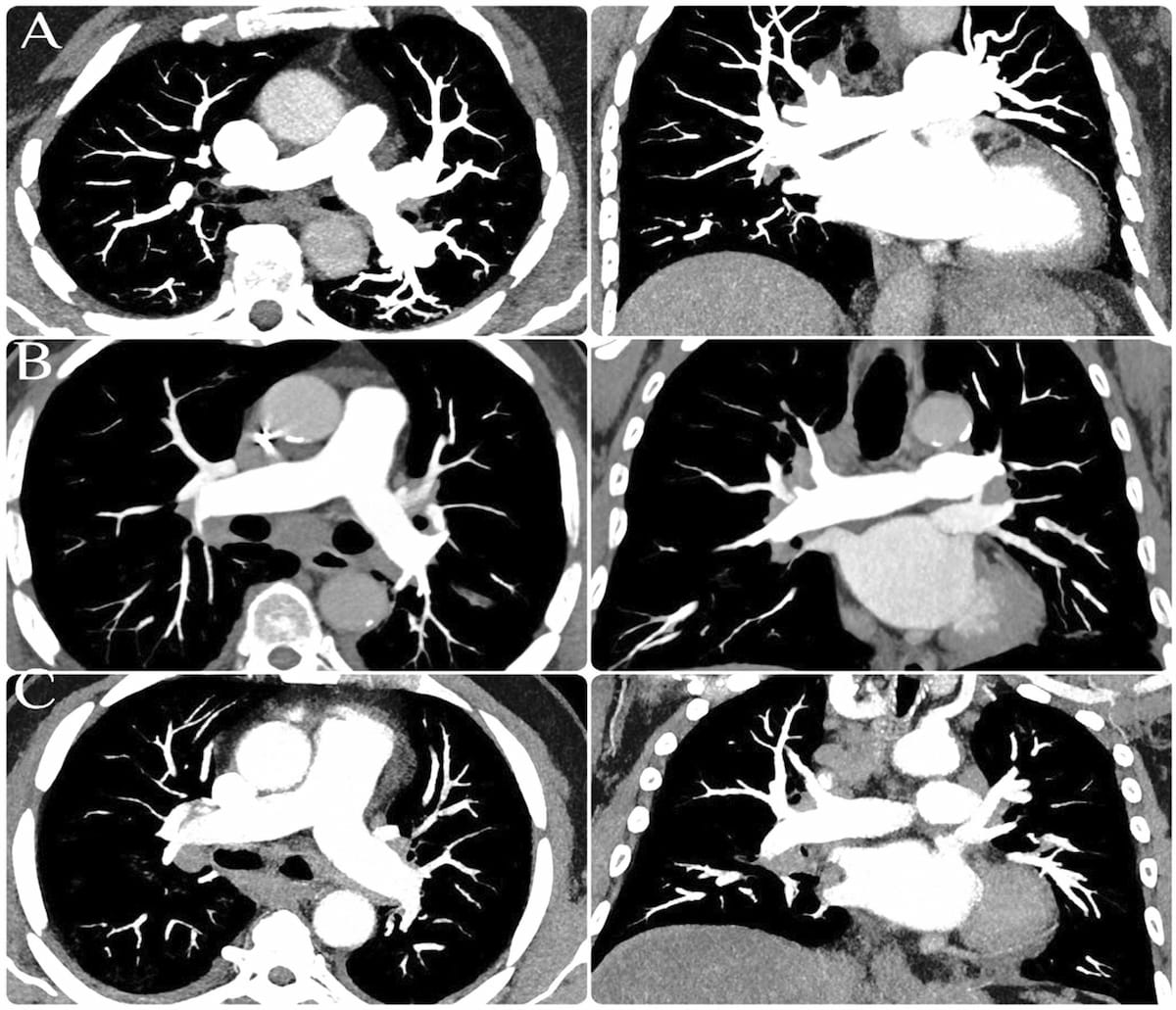 Study: Photon-Counting CT for Pulmonary Angiography Allows Significant ICM Reduction (Images courtesy of Academic Radiology.)