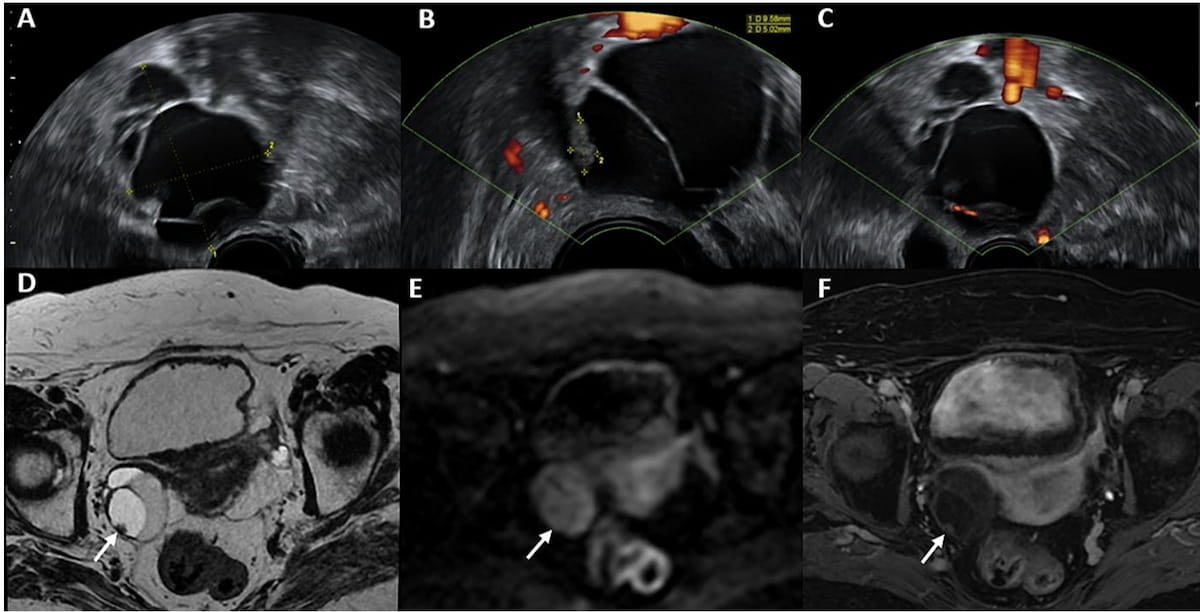 Is MRI More Effective than Ultrasound for Diagnosing Adnexal Lesions?