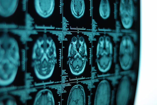 Study of Ofatumumab for Multiple Sclerosis Shows ‘Profoundly Suppressed MRI Lesion Activity’