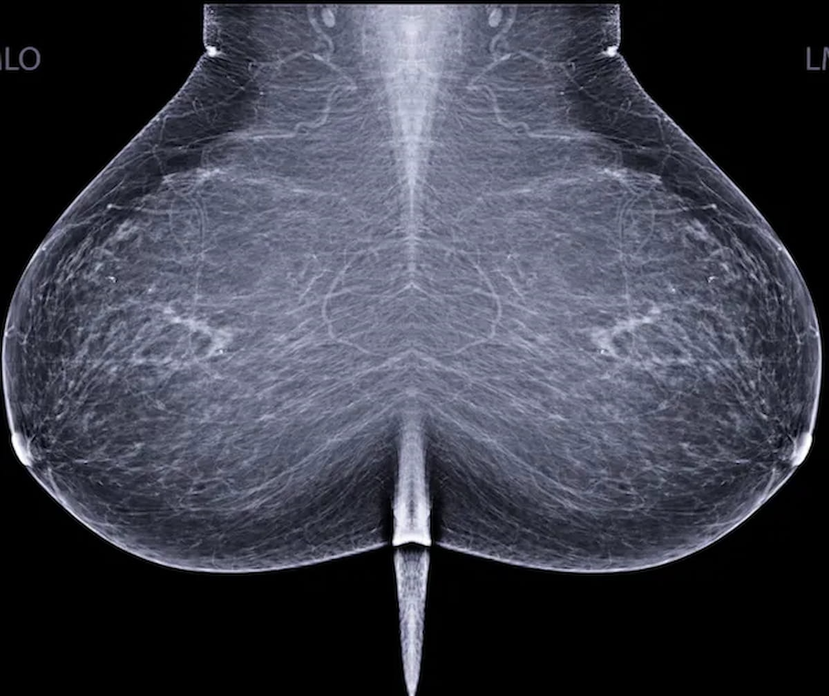 Biennial Mammography Over Annual Mammography?: USPSTF Issues Updated Breast Cancer Screening Recommendations