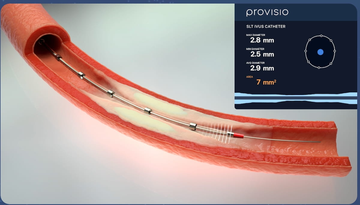 FDA Clears Catheter with Integrated Intravascular Ultrasound Technology