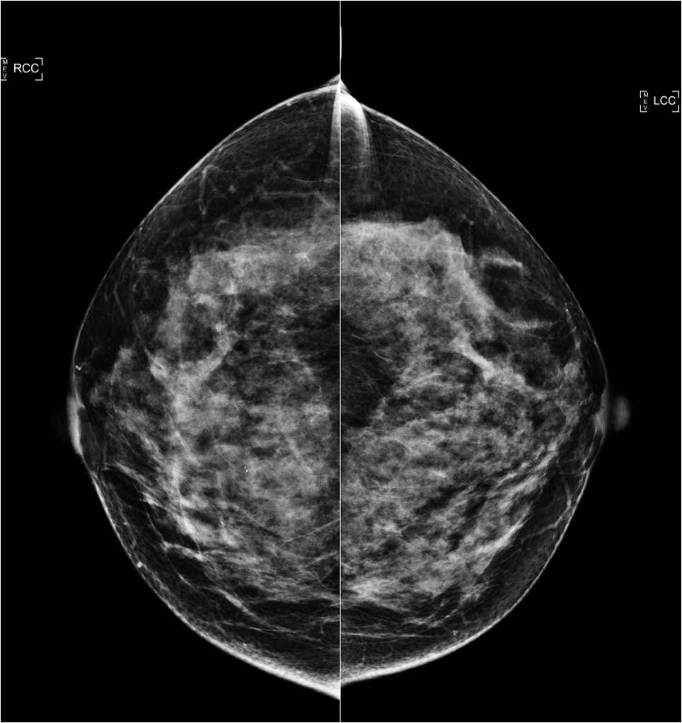 Image IQ: Ultrasound Screening of Dense Breasts